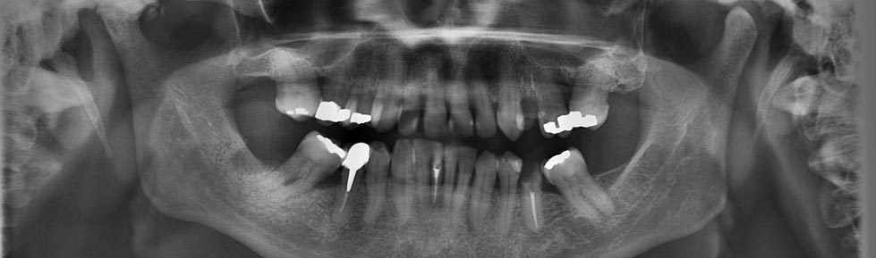 Dental X-Rays